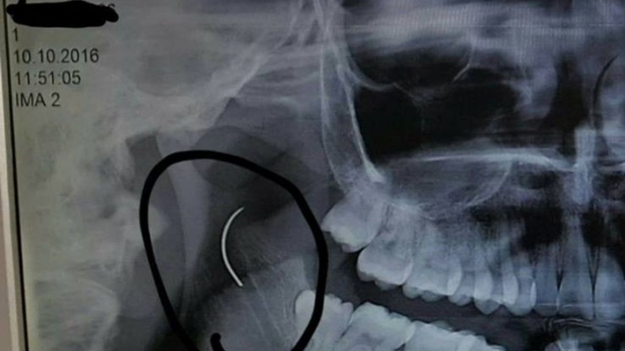 Boğazında unutulan ameliyat iğnesi 18 yıl sonra alındı